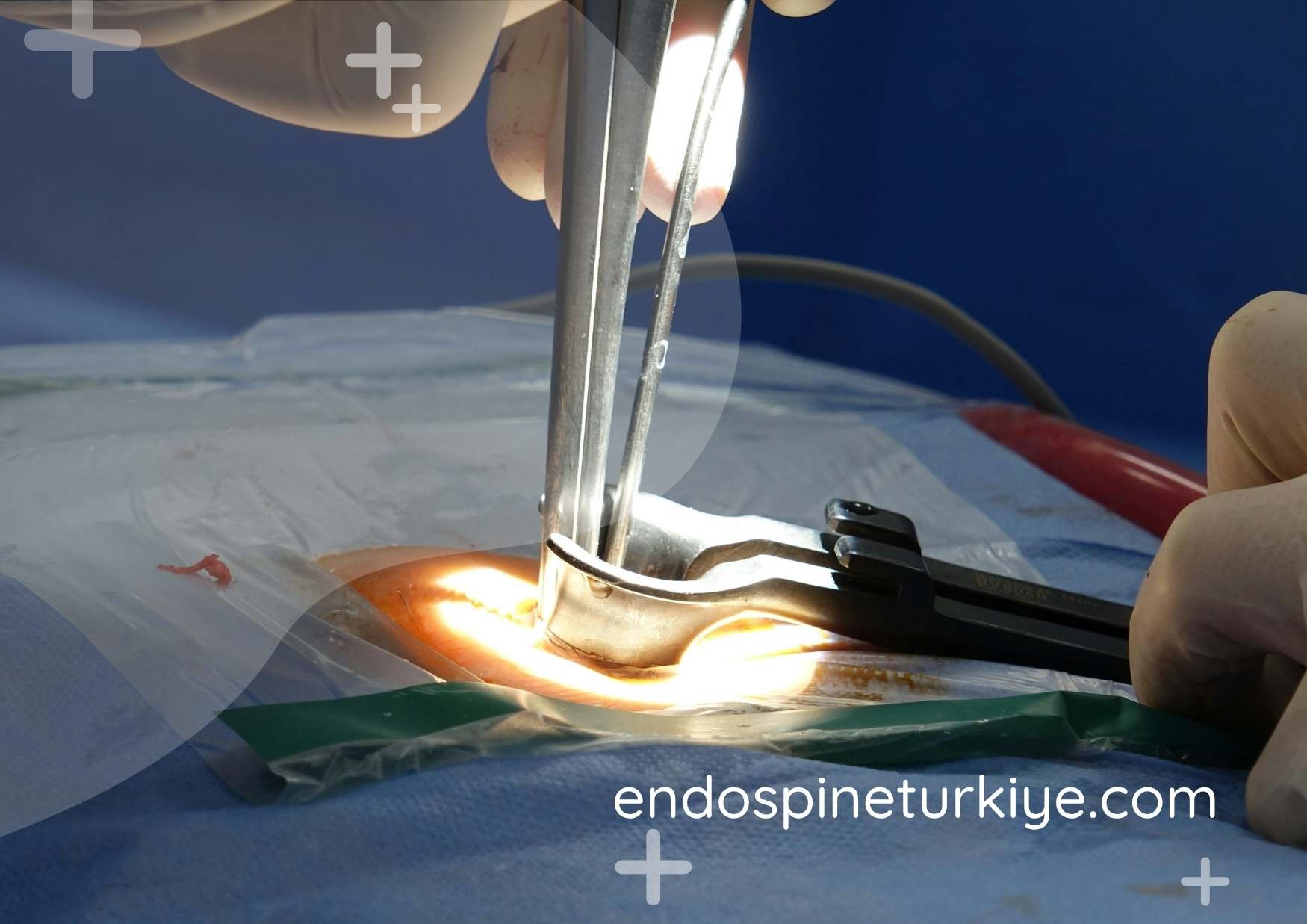 Dar Kanal Ameliyatı