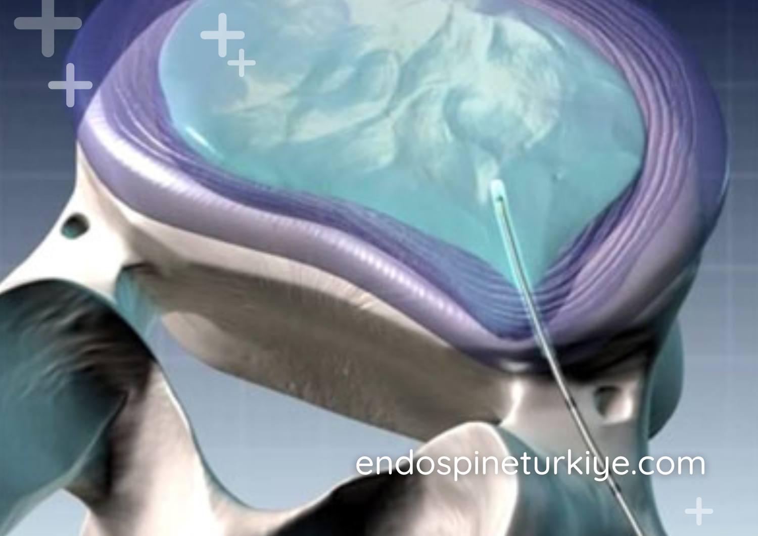 Lazerle Bel Fıtığı Tedavisi